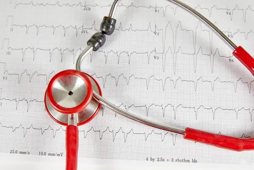 Irregular Heartbeat