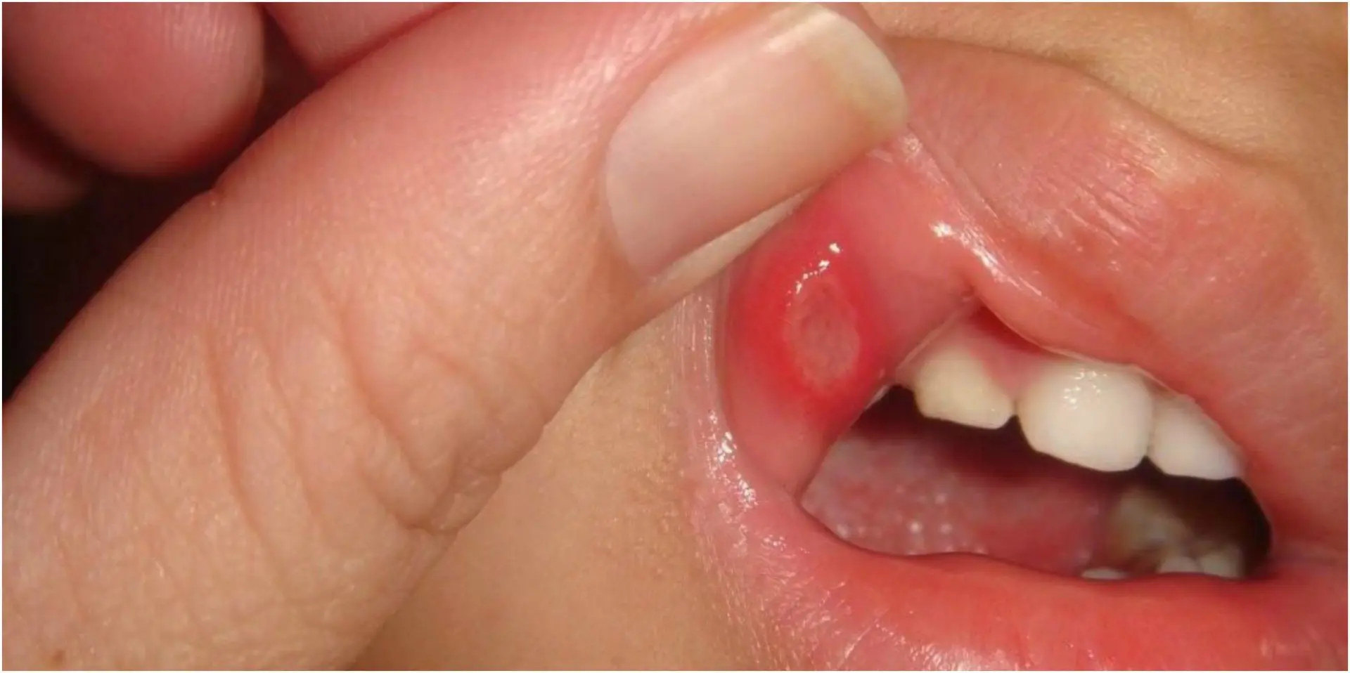 كيف تعالجين الفطريات المزعجة في فم طفلك؟