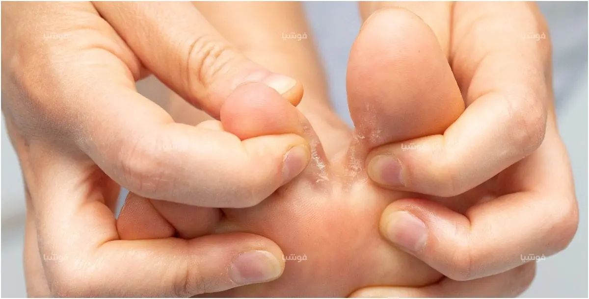 ما سبب تقشر الجلد بين أصابع القدم؟