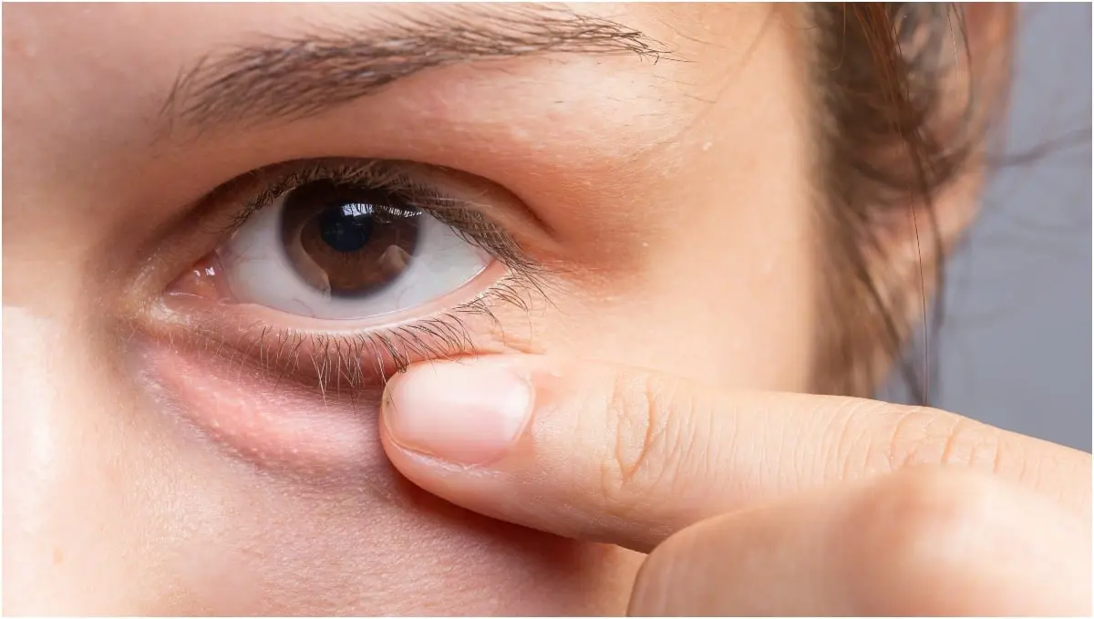 ما هي أسباب وطرق علاج انتفاخ العين؟