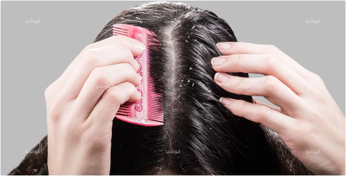 طرق طبيعية تخلصك من قشرة الشعر بشكل سهل وفعال