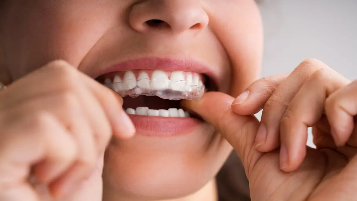 هل تُشكّل صيحة أمصال تبييض الأسنان الرائجة على تيك توك خطراً على صحتك؟‎