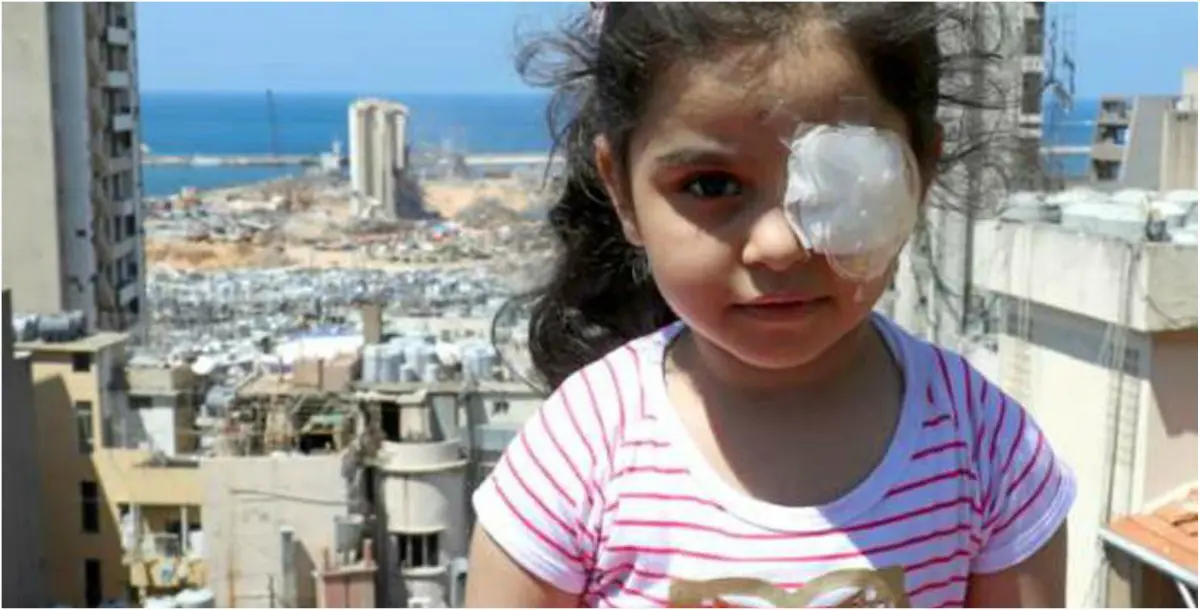"تدخل إماراتي" يمنح الأمل لطفلة بـ"استرجاع عينها" بعد انفجار بيروت