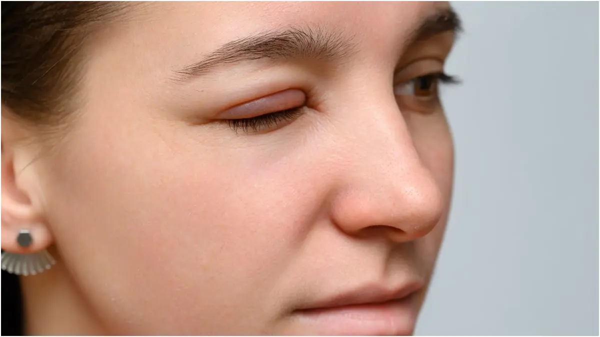 ما معنى إصابة جفون العين بتورم؟