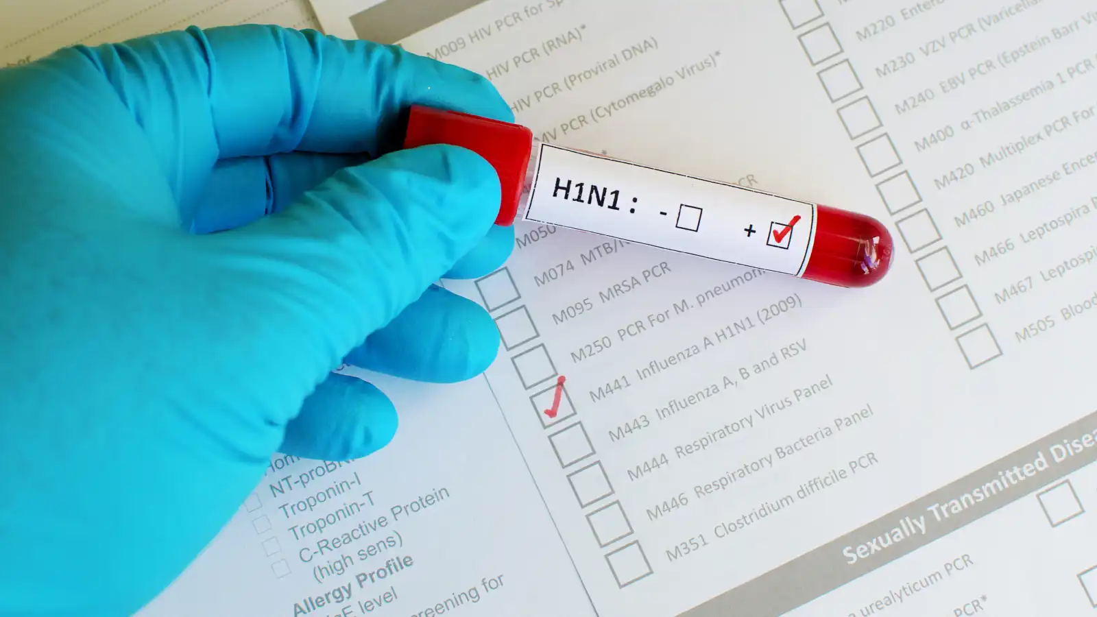  فيروس H1N1