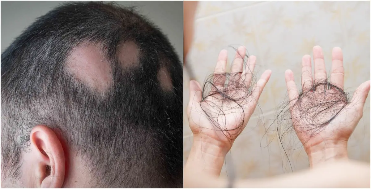 هل التوتر من فيروس كورونا يؤدي لتساقط الشعر وظهور الثعلبة؟