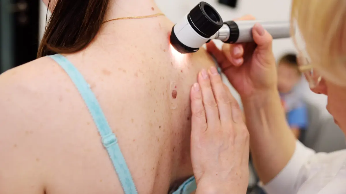 اختبار أول دواء لوقف سرطان الجلد بالذكاء الاصطناعي
