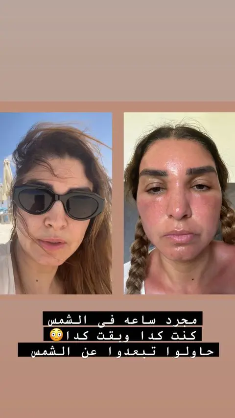 روجينا بملامح صادمة بعد تعرضها لحروق في وجهها