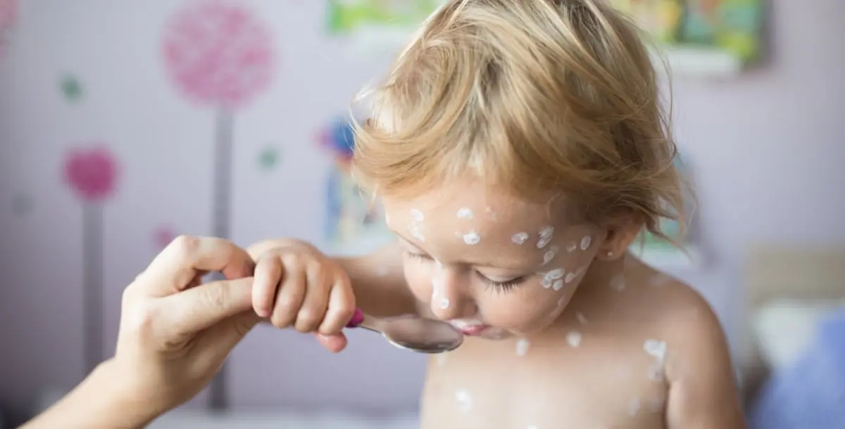 ماذا يأكل ويتجنب الطفل عندما يصاب بجدري الماء؟