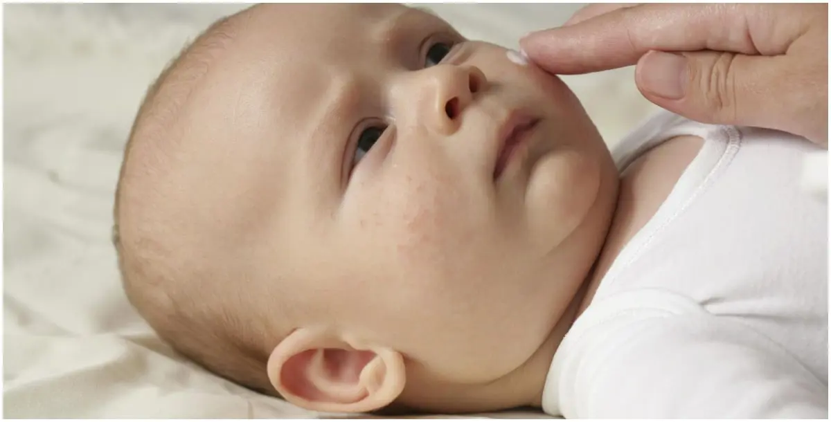 كيف يُستخدم حليب الأم في علاج حبوب الأطفال حديثي الولادة؟