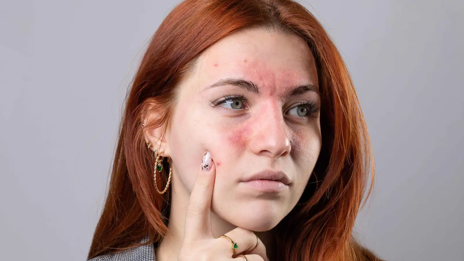 الأكزيما والصدفية.. دليل شامل لتمييز الأعراض