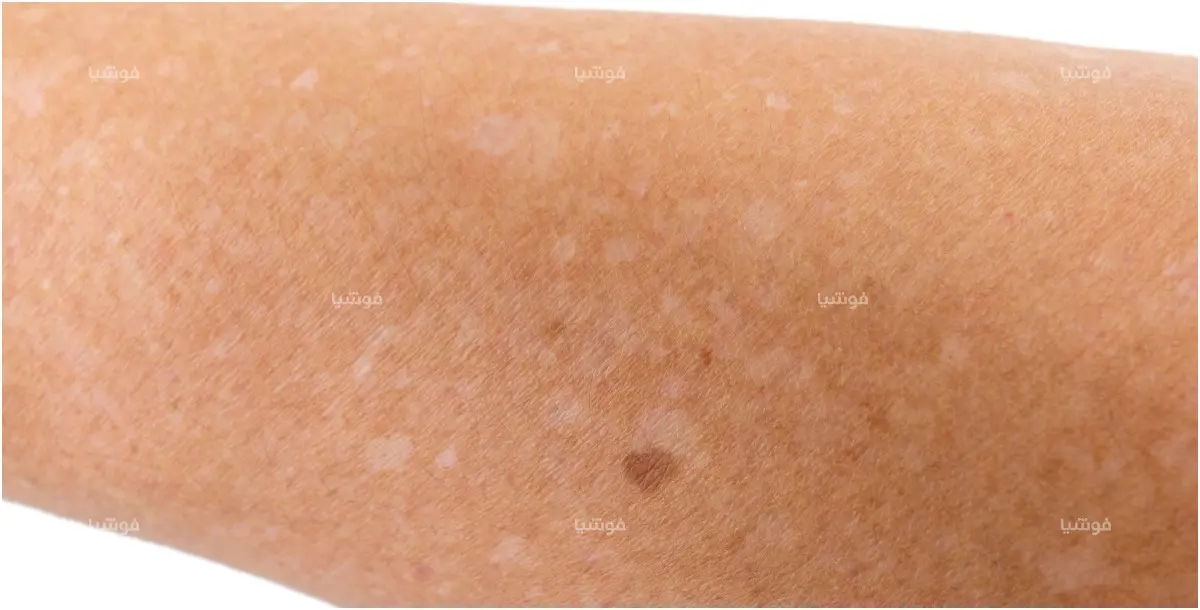 ماذا يعني ظهور بقع بيضاء على ذراعك؟