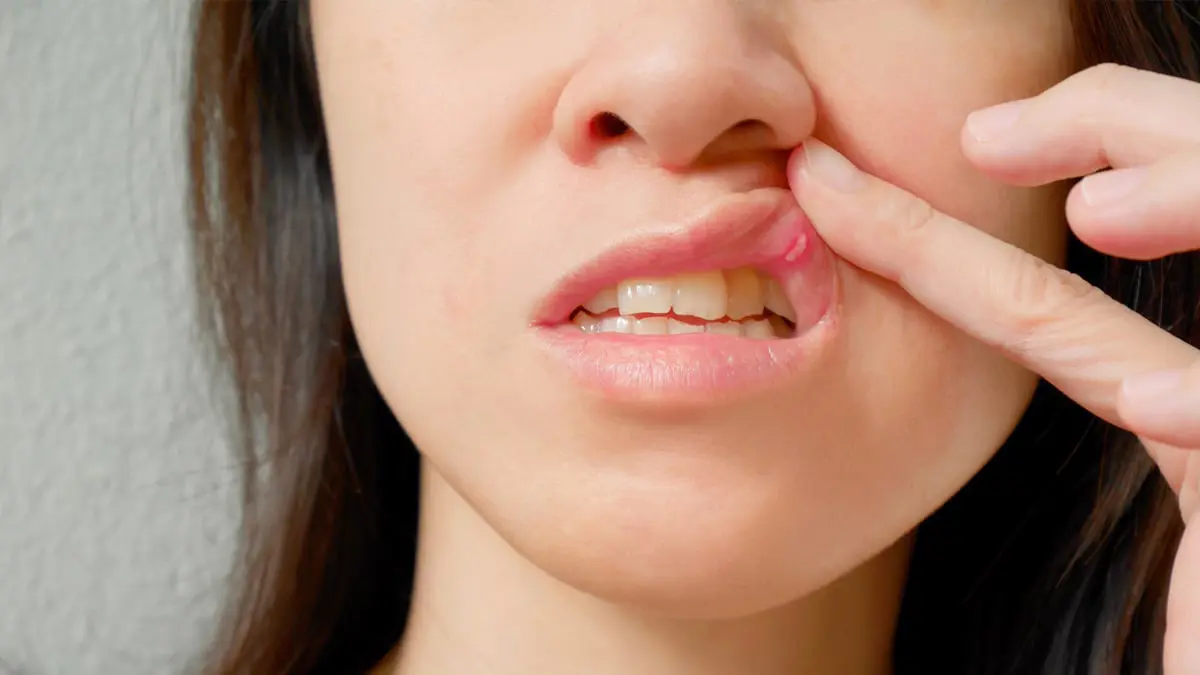 ما هي قروح الفم؟ وكيف يتم علاجها في المنزل؟