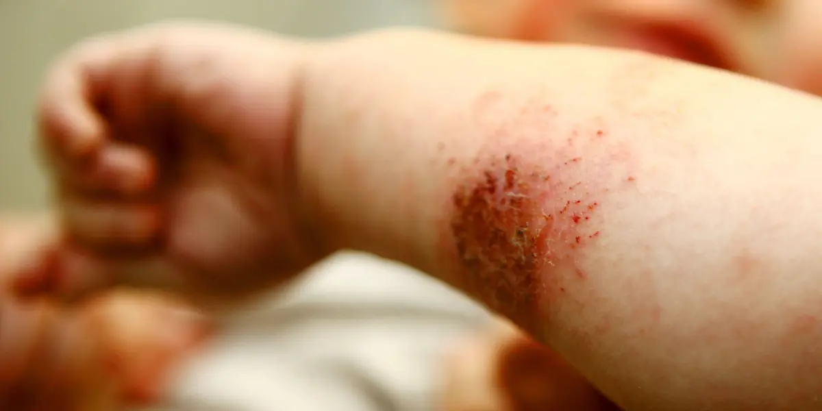 ما الذي يسبب التهاب الجلد العصبي لدى الأطفال؟