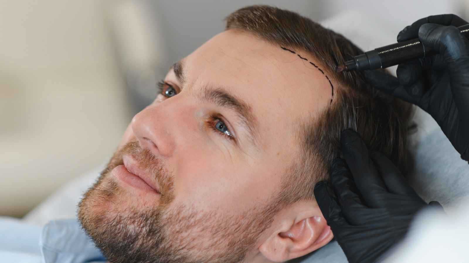 أحدث تقنيات زراعة الشعر لعام 2026