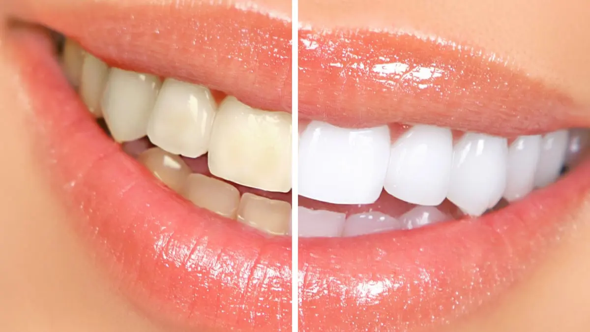 هل استخدام ورق الألومنيوم في تبييض الأسنان إجراء آمن؟