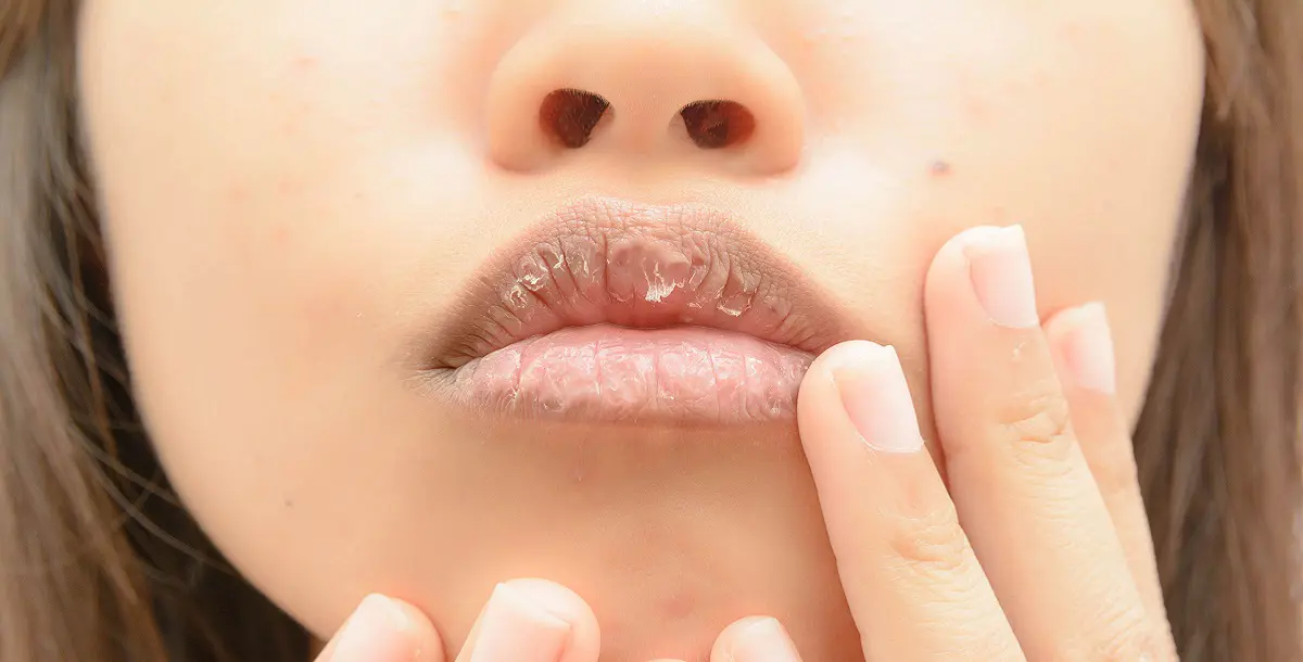 وصفة طبيعية للقضاء على جفاف الفم 