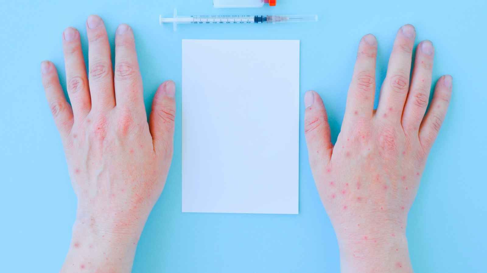 اليونيسيف تطلق مبادرة عاجلة لمواجهة جدري القردة
