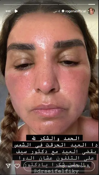 حروق وجه الفنانة روجينا