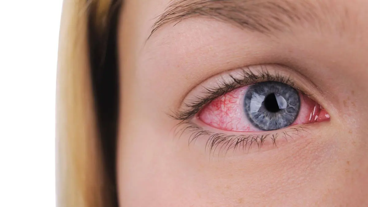 ما السر وراء استيقاظك بعيون حمراء كل صباح؟ وما العلاج؟