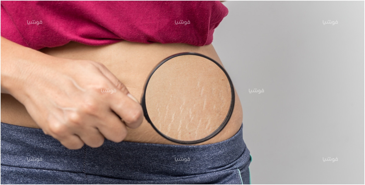 لماذا يصعب التخلص من علامات التمدد؟