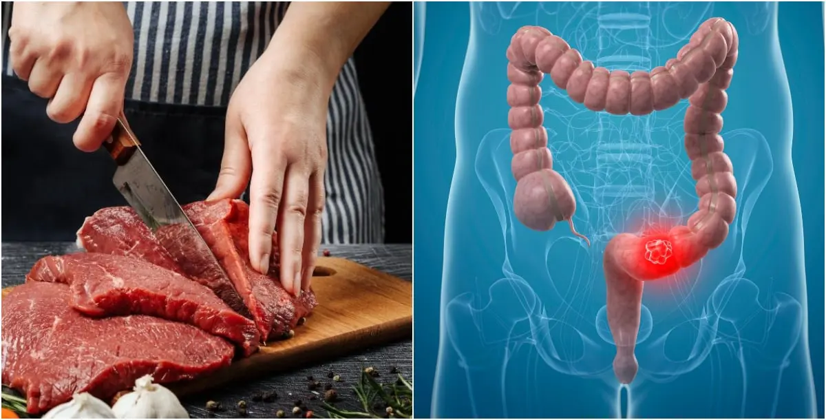 ما علاقة اللحوم المحفوظة والحمراء بسرطان القولون؟