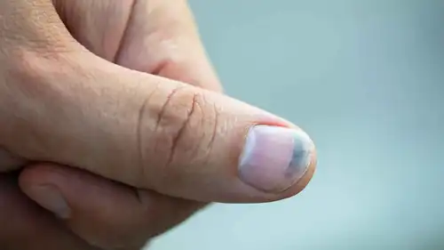 أسباب ازرقاق الأظافر وهل يشير إلى مرض خطير