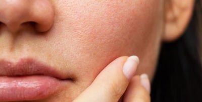 7 أسباب للبشرة الدهنية.. ما هي؟