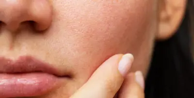 7 أسباب للبشرة الدهنية.. ما هي؟