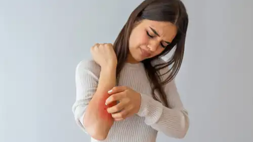 أسباب الأكزيما العصبية وطرق وقف الحكة